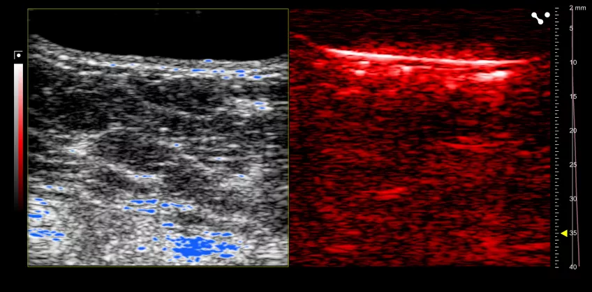 Photoacoustic image of breast tissue. Photo.