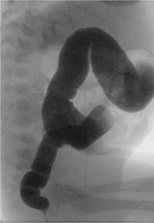 Pre-surgical image of dilated colon due to Hirshprungs disease. Photo. 